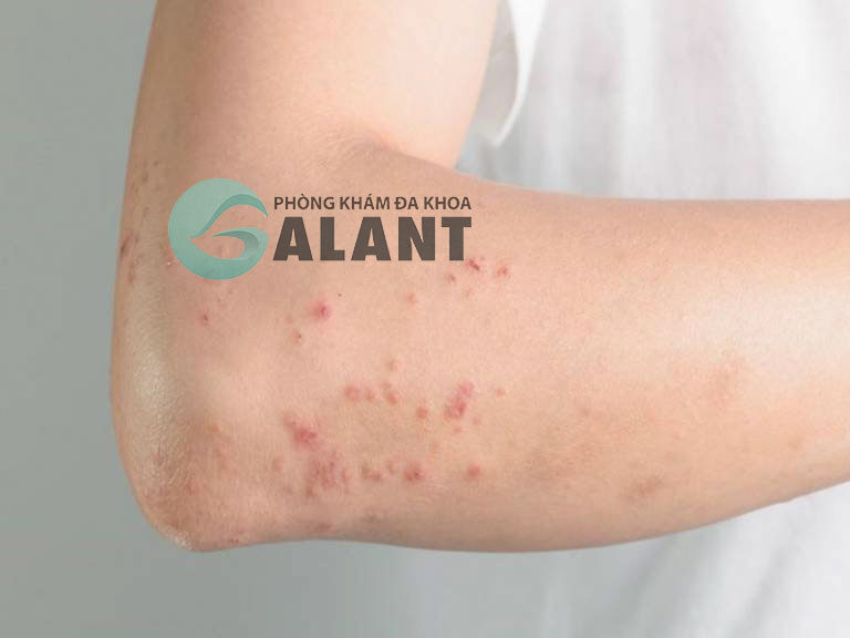 Bệnh Giun Đũa Ở Gà - Triệu Chứng, Nguyên Nhân Và Phương Pháp Điều Trị Hiệu Quả