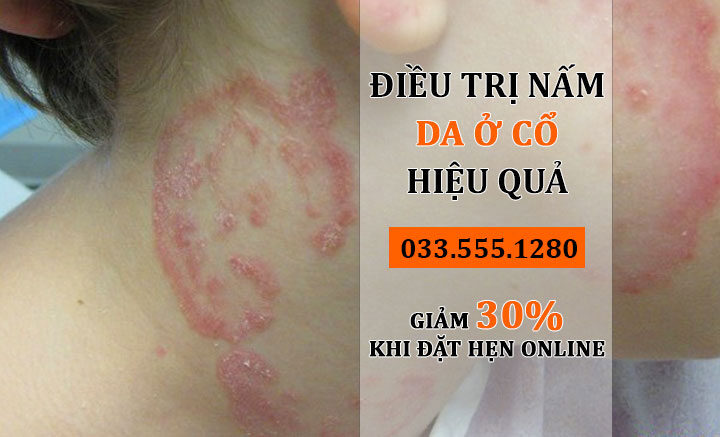 Bệnh nấm da ở gà - Dấu hiệu, nguyên nhân và cách điều trị hiệu quả