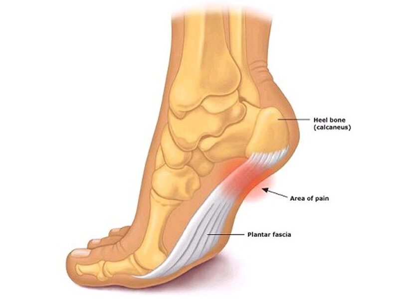 Bệnh sưng cụm bàn chân và cách xử lý